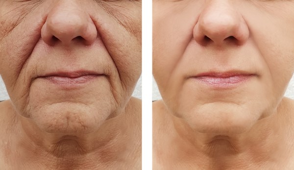 Learn more about Morpheus8 Treatment Hampton today!