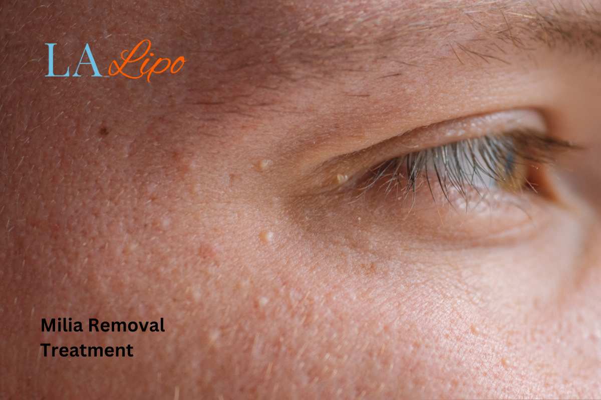 Cryopen Milia Removal: Is It the Easiest and Safest Option Hampton?