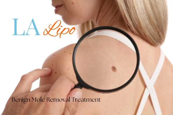 Why getting moles removed Hampton can boost your confidence!