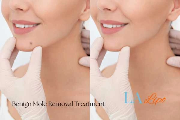 Woman's before and after results of being moles removal treatment Hampton