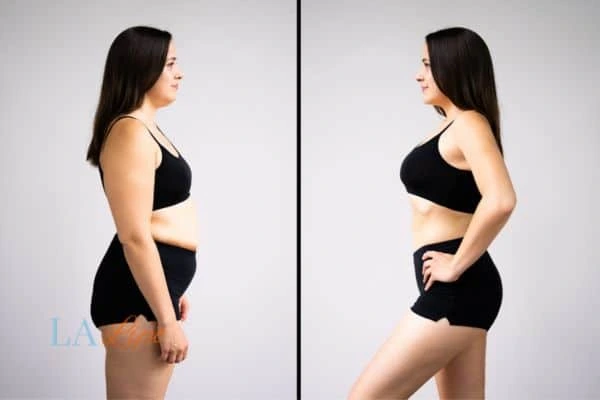 image of woman before and after results of LA-EMS Body Sculpting Hampton to help treat Diastasis recti