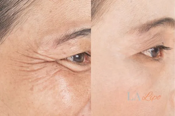 Before and after results of woman - HI-fu wrinkles reduction treatment Hampton