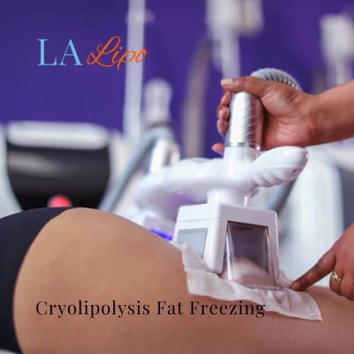 fat freezing - Cryolipolysis Hampton
