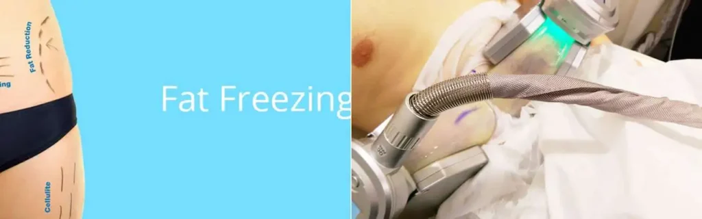 multi areas of a persons body having coolsculpting Hampton treatment