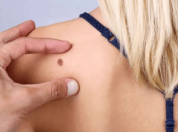woman having mole removal Hampton consultation before treatment.