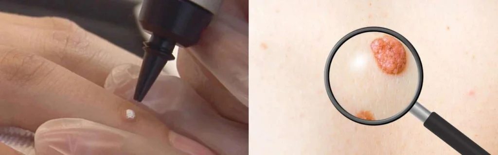 Person getting moles removed with cryopen Hampton