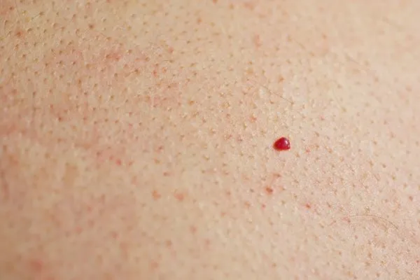 close up of a cherry angioma Hampton