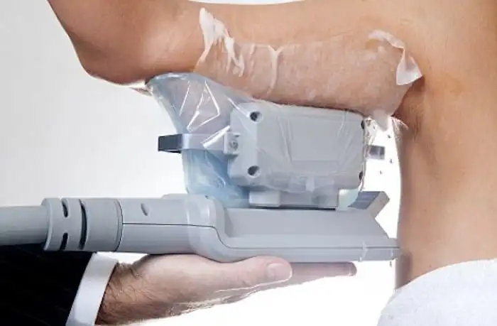 Picture of fat freezing Hampton on the upper arms.