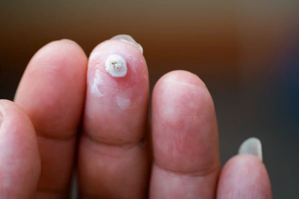 wart on person finger - cryotherapy to treat from LA LIPO Hampton