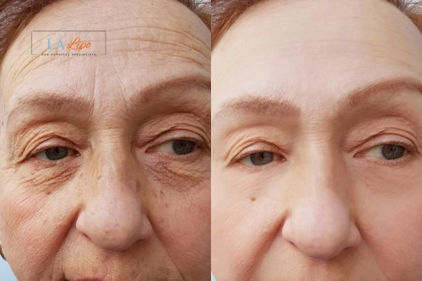 The powerful benefits of Morpheus8 Treatment Hampton - Call Our team today!
