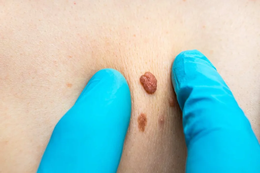 LA LIPO Cryopen Lesion Removal Prices Hampton