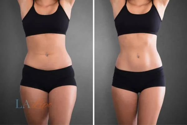 before and after results of non-surgical treatment to help a woman's body image and mental health Hampton