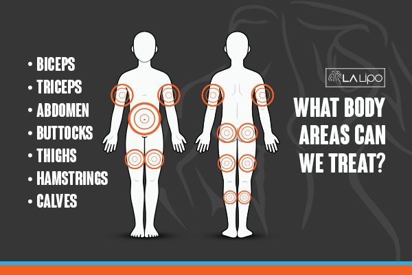 Diagram to show areas you can have LA-EMS Body Sculpting Treatment Hampton