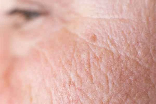 close up picture of a woman's face showing an age spot Hampton
