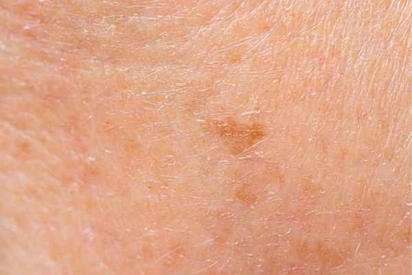 close up picture of age spots Hampton