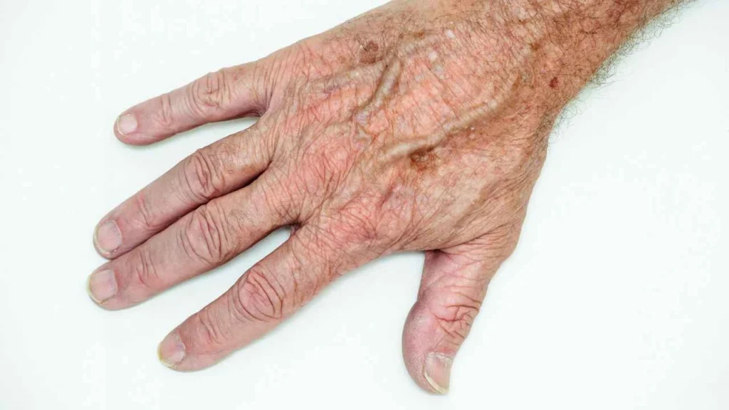 Male hand showing age spot Hampton