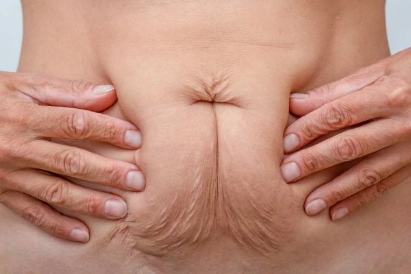 Image of a woman's stomach with loose skin - example of skin tightening Hampton options