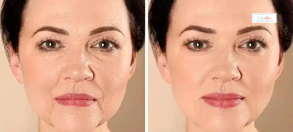 How Long Does It Take to See Results and How Long Do They Last Hampton?