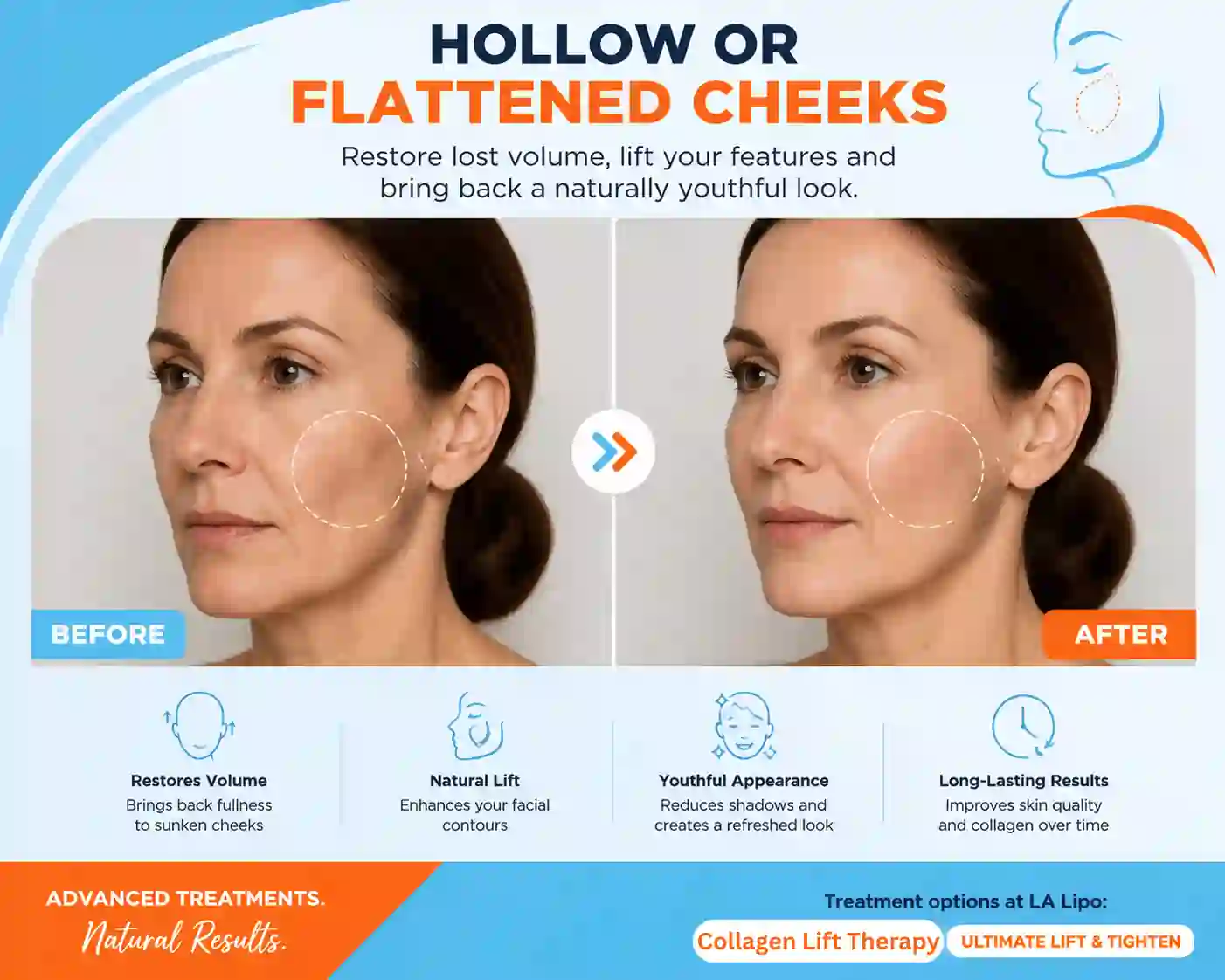 Sign #4: Hollow or Flattened Cheeks Hampton